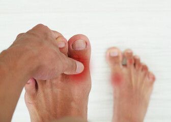 Hand holding sore toe. foot pain, men suffer from foot pain, gout injuries, joint pain. podiatry...