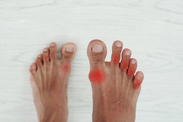 Men have foot pain, joint pain, gout, foot pain, aches and injuries.
