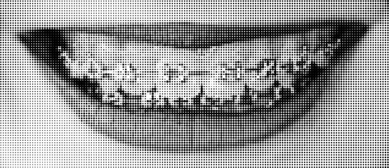 Halftone dotted smile with teeth and braces. Vector textured female lips for trendy y2k retro collage