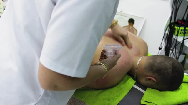Footage of a physiotherapist doing a massage with a cupping massage therapy on a patients back