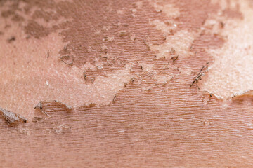 Skin peeling due to long-term sunburn