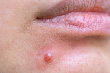 Inflamed acne that appears on a woman's face