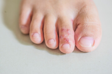 Children's feet with blisters on the toes