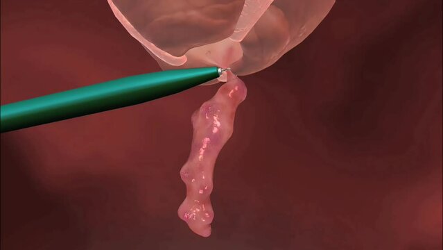 An appendectomy is the surgical removal of the appendix, which is located in the right lower side of the abdomen