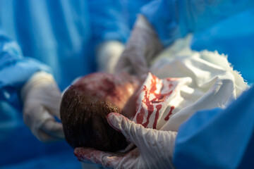 Professional anesthesiologist doctor medical team and assistant is performing baby cesarean section...