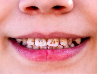 Dark plaque on children's teeth. Priestley's raid. Dental health concept. Oral care. Pediatric dentistry and periodontology. Dark spots on teeth