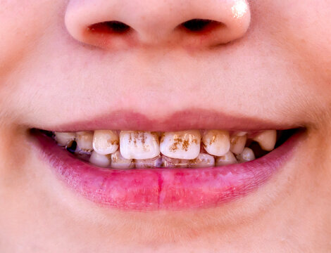 Dark plaque on children's teeth. Priestley's raid. Dental health concept. Oral care. Pediatric dentistry and periodontology. Dark spots on teeth