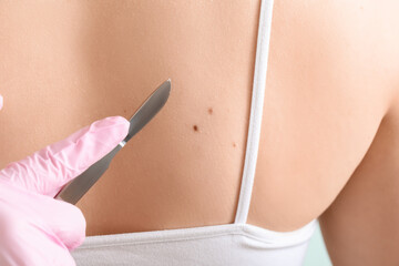 Surgeon with scalpel and moles on woman's body, back view