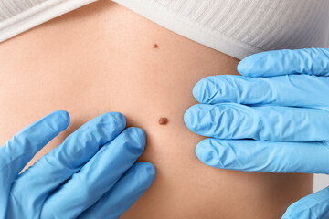 Dermatologist examining mole on woman's belly, closeup