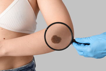 Dermatologist with magnifier examining birthmark on woman's arm against light background, closeup