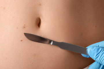 Surgeon with scalpel and moles on woman's belly, closeup
