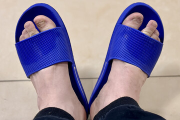 Fungal onychosis is an infection of the toenails of unknown person in a blue slipper indoors. Close-up