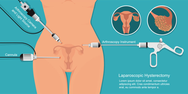Laparoscopic surgery for treatment fibroids and cysts in the uterus.