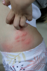 Red, swollen and itchy spots on skin caused by insect bites or allergy. Skin reaction to insect bites.