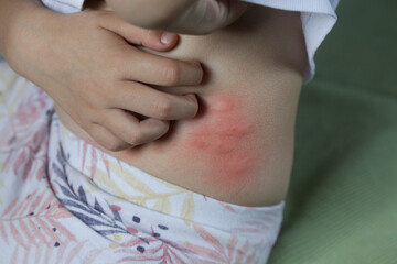 Red, swollen and itchy spots on skin caused by insect bites or allergy. Skin reaction to insect bites.