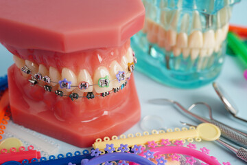 Orthodontic ligatures rings and ties, elastic rubber bands on orthodontic braces, model for dentist...