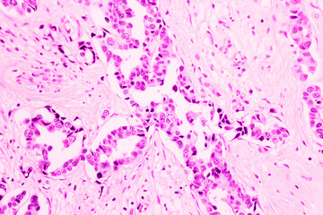 Backgrounds of human cells tissue of cervix under the microscope in pathology lab.View in microscopic of ductal cell carcinoma, adenonocarcinoma from human breast cancer, tissue section by H and E