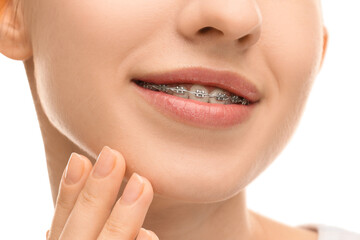 Obraz premium Smiling woman with dental braces on white background, closeup