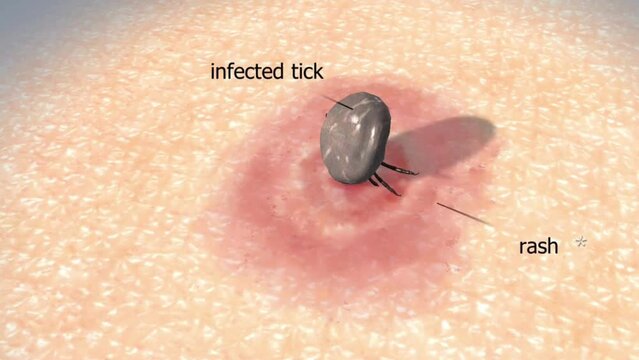 Castor Bean tick on human skin