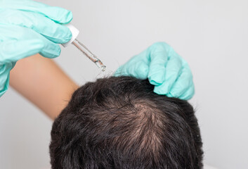 man with baldness on head.doctor in surgical gloves holding syringe, derma roller, oil spray or serum.bald on top of head, showed with comb.hair growth stimulation concept,treatment.isolated guy