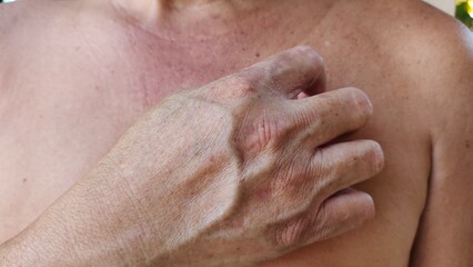 close up the hand scratching the rash hives allergy and inflammation skin, reaction and urticaria,...