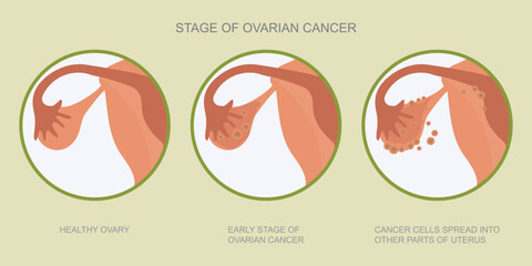 Ovarian cancer refers to any cancerous growth.