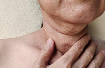 Portrait the hand holding the flabbiness adipose sagging skin, neck wattle and cellulite, crack and flabby skin, wrinkle and loose under the chin of the woman, health care and medical concept.