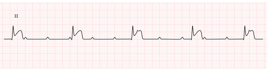 EKG Monitor in lead II Showing  Complete heart block with STEMI at Inferior Wall