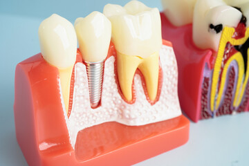 Dental implant, artificial tooth roots into jaw, root canal of dental treatment, gum disease, teeth model for dentist studying about dentistry.