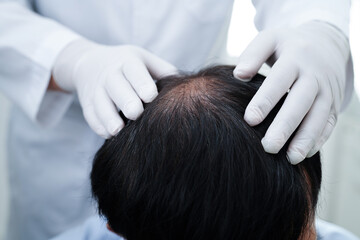 Doctor touch bold head in man, hair loss treatment health problem.