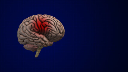 Brain bleed or an intracranial Hemorrhage