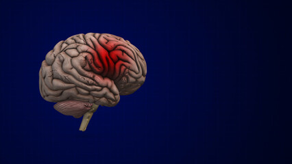 Brain bleed or an intracranial Hemorrhage