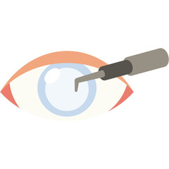 Cataract Surgery Illustration