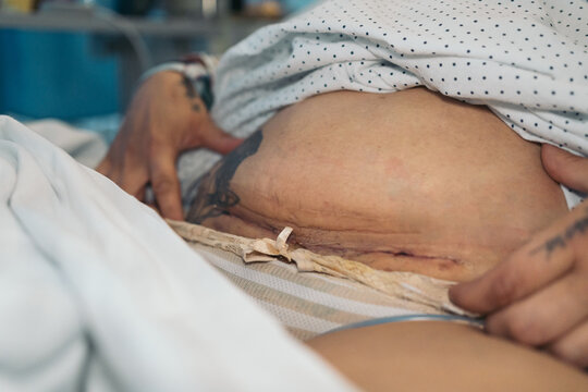 Close-up of a woman's fresh uterine fibroid removal scar with visible previous cesarean marks, unidentifiable.