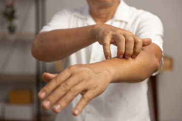 Senior man itchy and scratching arm and legs because dry skin.