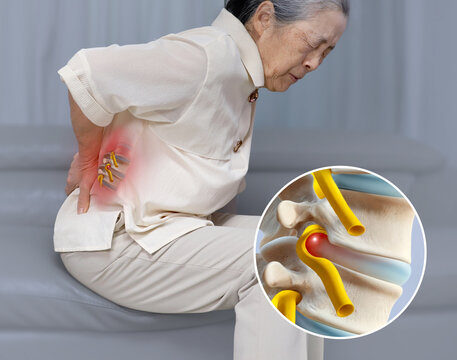 An elderly Asian woman sitting on a sofa is experiencing back pain due to a herniated disc.