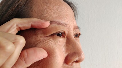 portrait the fingers holding the flabbiness and wrinkle, ptosis and loose beside the eyelid, Flabby...