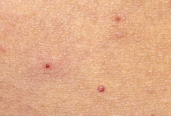 Symptoms of Body Skin Macro Close-up