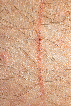 A Scratch On Real Imperfect Skin