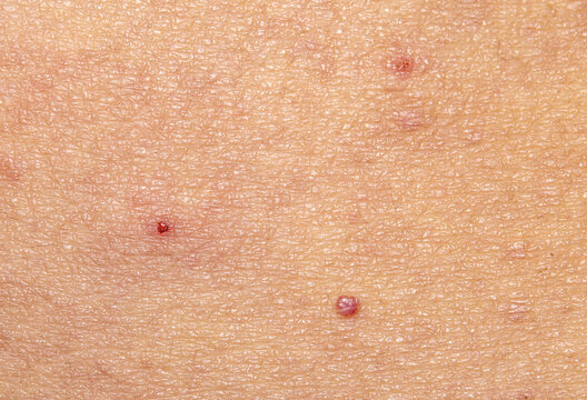 Symptoms of Body Skin Macro Close-up