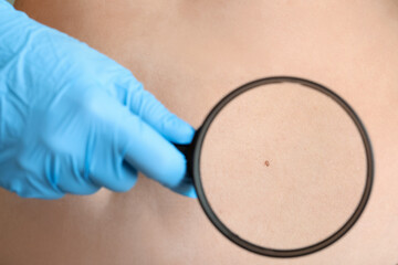 Dermatologist with magnifier examining moles on woman's belly, closeup