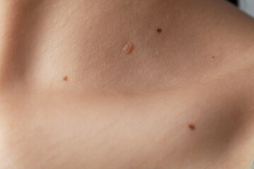Woman with moles on her body, closeup