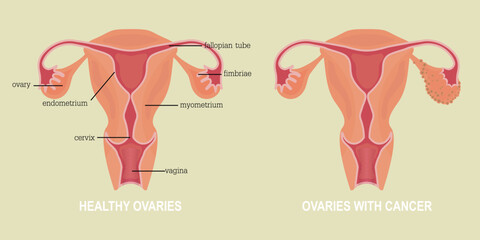 Ovarian cancer refers to any cancerous growth that begins in the ovaries.