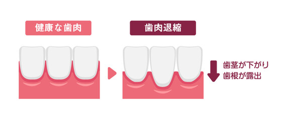 健康な歯肉と歯肉退縮（歯茎の下がり）の比較イラスト