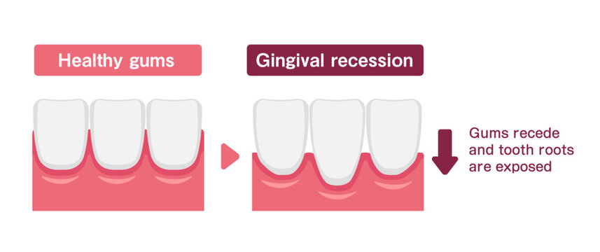Vector illustration of healthy gums and gingival recession