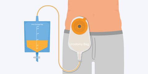 Urostomy bag containing urine flow through small bowel stoma.