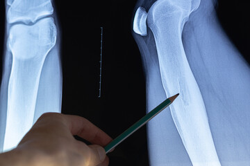 Doctor examining osteoid osteoma, benign bone tumor. X-ray and MRI, MRT, CT with marked sclerosis...