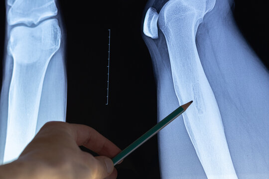 Doctor examining osteoid osteoma, benign bone tumor. X-ray and MRI, MRT, CT with marked sclerosis around the nidus. Medical treatmant concept. Diagnosis of the disease humans bones.