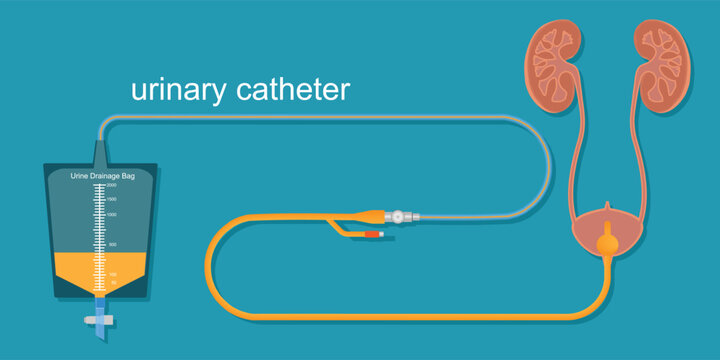 Urinary catheter in the body.