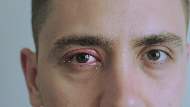 Portrait of a man with an eye condition. Allergy relief medications that help combat allergies, which can contribute to the development of conjunctivitis, such as air filters and anti-allergenic 